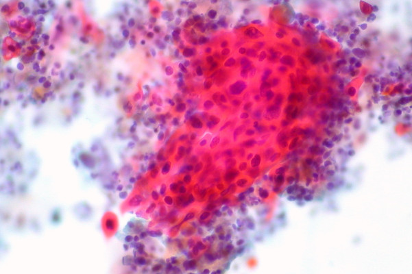 Trialjectory uses self-reported clinical data to match cancer patients with clinical trials